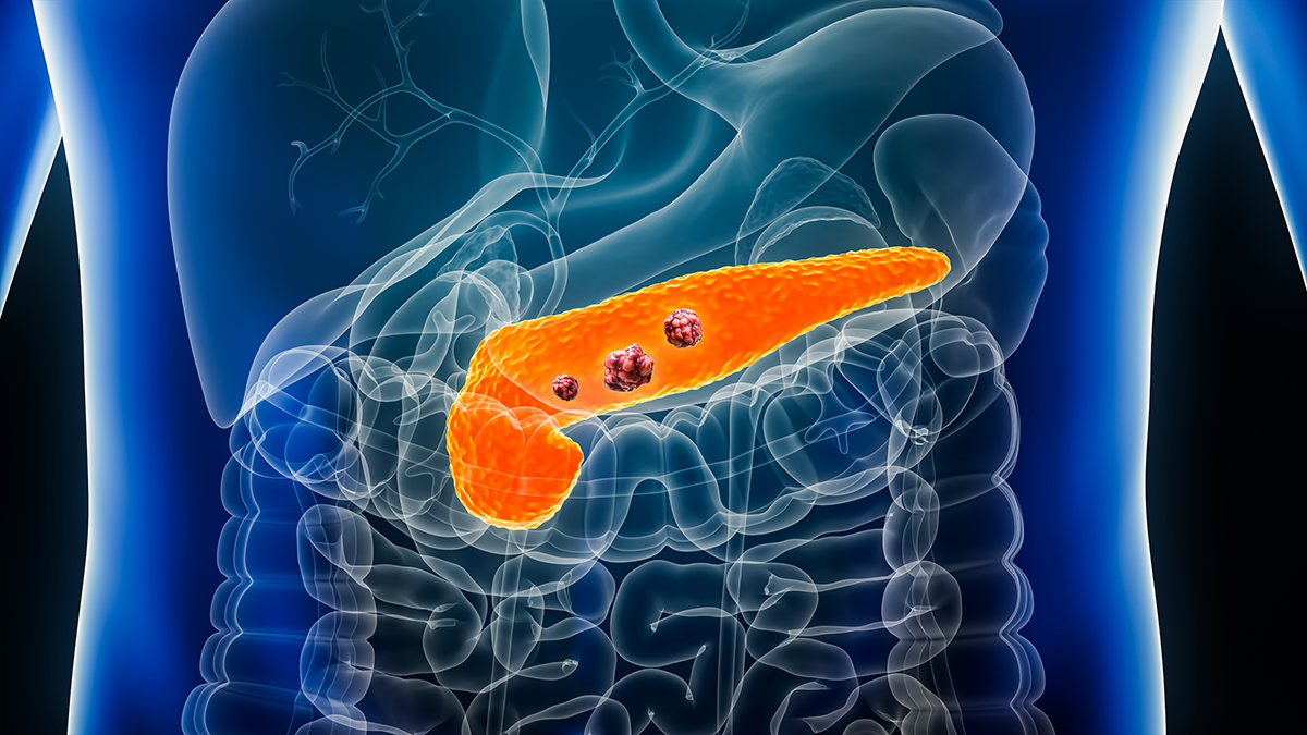 Pancreas or pancreatic cancer with organs and tumors or cancerous cells 3D rendering illustration with male body.