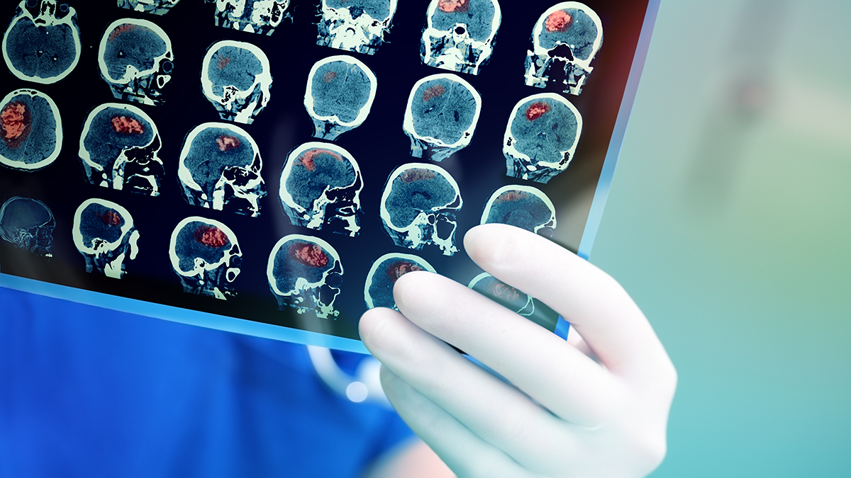 white gloved hand holding xray film with a series of mri brain images