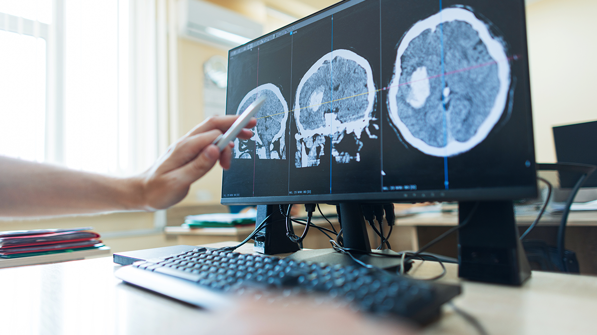 hand points with a pen at a computer monitor displaying multiple cross-section brain CT scans showing a large tumor, diagnostic