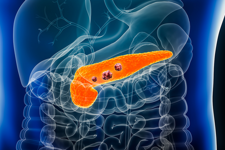 Pancreas or pancreatic cancer with organs and tumors or cancerous cells 3D rendering illustration with male body.