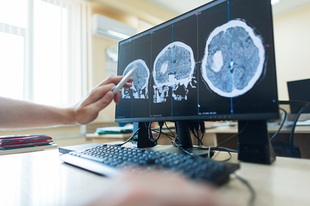 hand points with a pen at a computer monitor displaying multiple cross-section brain CT scans showing a large tumor, diagnostic