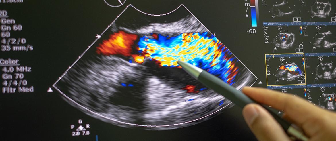 photo of a color ultrasound screen