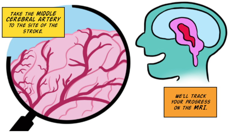 stroke illus 4