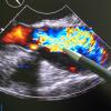 photo of a color ultrasound screen